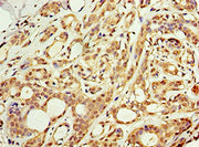 Immunohistochemistry of paraffin-embedded human breast cancer using CSB-PA709601ESR1HU at dilution of 1:100