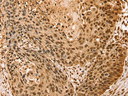 The image on the left is immunohistochemistry of paraffin-embedded Human esophagus cancer tissue using CSB-PA712032(SNX8 Antibody) at dilution 1/25, on the right is treated with fusion protein. (Original magnification: ×200)