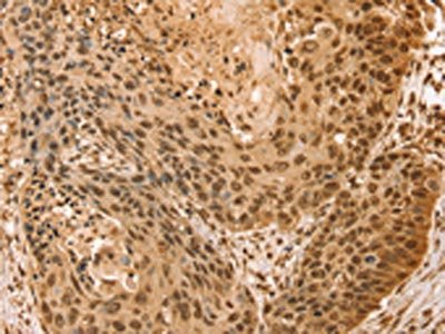 The image on the left is immunohistochemistry of paraffin-embedded Human esophagus cancer tissue using CSB-PA712032(SNX8 Antibody) at dilution 1/25, on the right is treated with fusion protein. (Original magnification: ×200)