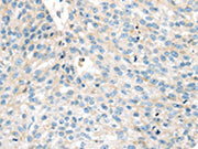 The image on the left is immunohistochemistry of paraffin-embedded Human breast cancer tissue using CSB-PA712110(VPS26A Antibody) at dilution 1/35, on the right is treated with synthetic peptide. (Original magnification: ×200)