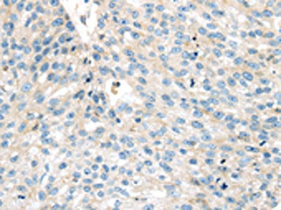 The image on the left is immunohistochemistry of paraffin-embedded Human breast cancer tissue using CSB-PA712110(VPS26A Antibody) at dilution 1/35, on the right is treated with synthetic peptide. (Original magnification: ×200)