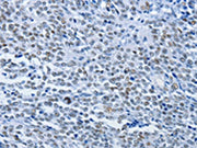 The image on the left is immunohistochemistry of paraffin-embedded Human ovarian cancer tissue using CSB-PA712321(CBX1 Antibody) at dilution 1/30, on the right is treated with synthetic peptide. (Original magnification: ×200)