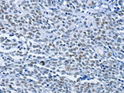 The image on the left is immunohistochemistry of paraffin-embedded Human ovarian cancer tissue using CSB-PA712321(CBX1 Antibody) at dilution 1/30, on the right is treated with synthetic peptide. (Original magnification: ×200)