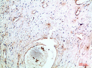 Immunohistochemical analysis of paraffin-embedded human-cervical-cancer, antibody was diluted at 1:200