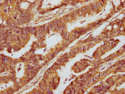 IHC image of CSB-PA715035LA01HU diluted at 1:300 and staining in paraffin-embedded human colon cancer performed on a Leica BondTM system. After dewaxing and hydration, antigen retrieval was mediated by high pressure in a citrate buffer (pH 6.0). S...