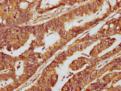 IHC image of CSB-PA715035LA01HU diluted at 1:300 and staining in paraffin-embedded human colon cancer performed on a Leica BondTM system. After dewaxing and hydration, antigen retrieval was mediated by high pressure in a citrate buffer (pH 6.0). S...