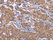 The image on the left is immunohistochemistry of paraffin-embedded Human gastic cancer tissue using CSB-PA715796(EP300 Antibody) at dilution 1/20, on the right is treated with synthetic peptide. (Original magnification: ×200)