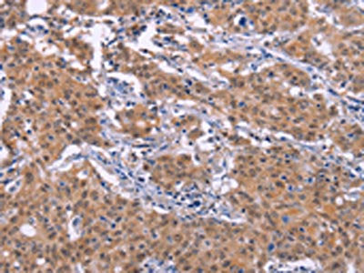 The image on the left is immunohistochemistry of paraffin-embedded Human gastic cancer tissue using CSB-PA715796(EP300 Antibody) at dilution 1/20, on the right is treated with synthetic peptide. (Original magnification: ×200)