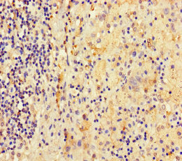 Immunohistochemistry of paraffin-embedded human lung cancer using CSB-PA716349LA01HU at dilution of 1:100