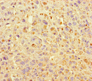 Immunohistochemistry of paraffin-embedded human melanoma using CSB-PA716354LA01HU at dilution of 1:100