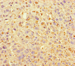 Immunohistochemistry of paraffin-embedded human melanoma using CSB-PA716354LA01HU at dilution of 1:100