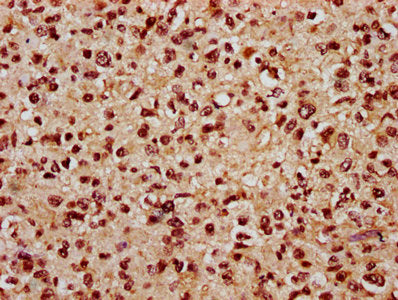 IHC image of CSB-PA716370LA01HU diluted at 1:800 and staining in paraffin-embedded human glioma performed on a Leica BondTM system. After dewaxing and hydration, antigen retrieval was mediated by high pressure in a citrate buffer (pH 6.0). Section...
