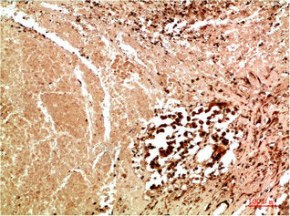 Immunohistochemical analysis of paraffin-embedded Human Lung Carcinoma Tissue using JNK3 Rabbit pAb diluted at 1:200