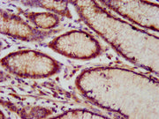 IHC image of CSB-PA717453LA01HU diluted at 1:800 and staining in paraffin-embedded human gastric cancer performed on a Leica BondTM system. After dewaxing and hydration, antigen retrieval was mediated by high pressure in a citrate buffer (pH 6.0)....
