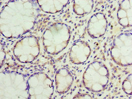 Immunohistochemistry of paraffin-embedded human colon cancer using CSB-PA718803ESR2HU at dilution of 1:100