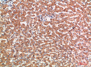 Immunohistochemical analysis of paraffin-embedded human-liver-cancer, antibody was diluted at 1:200