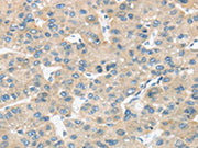 The image on the left is immunohistochemistry of paraffin-embedded Human liver cancer tissue using CSB-PA718808(TIRAP Antibody) at dilution 1/30, on the right is treated with fusion protein. (Original magnification: ×200)