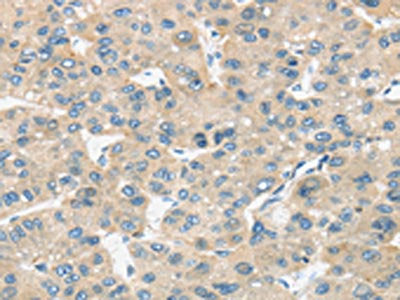 The image on the left is immunohistochemistry of paraffin-embedded Human liver cancer tissue using CSB-PA718808(TIRAP Antibody) at dilution 1/30, on the right is treated with fusion protein. (Original magnification: ×200)