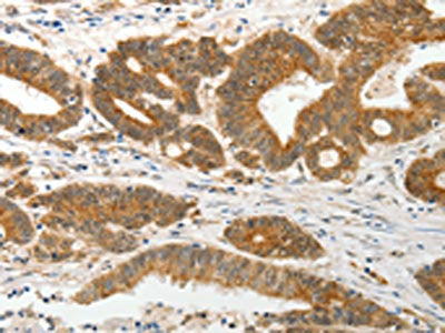 The image on the left is immunohistochemistry of paraffin-embedded Human colon cancer tissue using CSB-PA719331(SLC12A1 Antibody) at dilution 1/15, on the right is treated with fusion protein. (Original magnification: ×200)