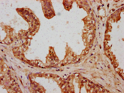 IHC image of CSB-PA719395LA01HU diluted at 1:400 and staining in paraffin-embedded human prostate cancer performed on a Leica BondTM system. After dewaxing and hydration, antigen retrieval was mediated by high pressure in a citrate buffer (pH 6.0)...