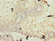 Immunohistochemistry of paraffin-embedded human breast cancer using CSB-PA719409LA01HU at dilution of 1:100