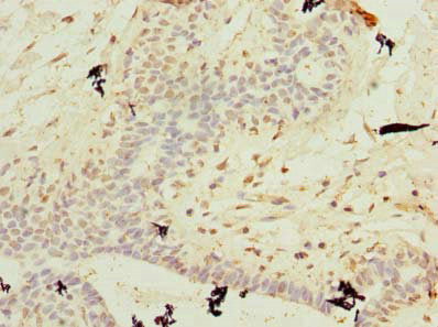 Immunohistochemistry of paraffin-embedded human breast cancer using CSB-PA719409LA01HU at dilution of 1:100