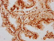 IHC image of CSB-PA719416LA01HU diluted at 1:300 and staining in paraffin-embedded human prostate cancer performed on a Leica BondTM system. After dewaxing and hydration, antigen retrieval was mediated by high pressure in a citrate buffer (pH 6.0)...