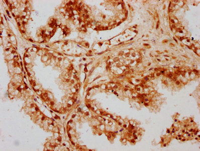 IHC image of CSB-PA719416LA01HU diluted at 1:300 and staining in paraffin-embedded human prostate cancer performed on a Leica BondTM system. After dewaxing and hydration, antigen retrieval was mediated by high pressure in a citrate buffer (pH 6.0)...