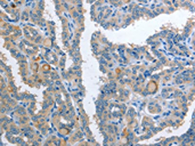 The image on the left is immunohistochemistry of paraffin-embedded Human thyroid cancer tissue using CSB-PA719443(AP2S1 Antibody) at dilution 1/25, on the right is treated with fusion protein. (Original magnification: ×200)