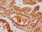 IHC image of CSB-PA719619LA01HU diluted at 1:500 and staining in paraffin-embedded human prostate cancer performed on a Leica BondTM system. After dewaxing and hydration, antigen retrieval was mediated by high pressure in a citrate buffer (pH 6.0)...