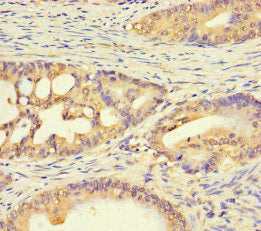 Immunohistochemistry of paraffin-embedded human colon cancer using CSB-PA719622LA01HU at dilution of 1:100