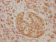 IHC image of CSB-PA721207LA01HU diluted at 1:100 and staining in paraffin-embedded human pancreatic cancer performed on a Leica BondTM system. After dewaxing and hydration, antigen retrieval was mediated by high pressure in a citrate buffer (pH 6....