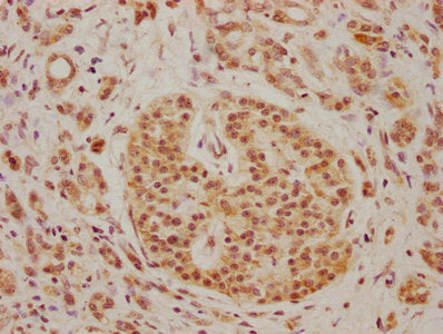 IHC image of CSB-PA721207LA01HU diluted at 1:100 and staining in paraffin-embedded human pancreatic cancer performed on a Leica BondTM system. After dewaxing and hydration, antigen retrieval was mediated by high pressure in a citrate buffer (pH 6....