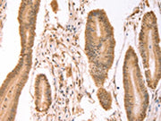 The image on the left is immunohistochemistry of paraffin-embedded Human colon cancer tissue using CSB-PA721303(PTMA Antibody) at dilution 1/25, on the right is treated with synthetic peptide. (Original magnification: ×200)