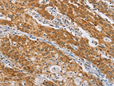 The image on the left is immunohistochemistry of paraffin-embedded Human gastic cancer tissue using CSB-PA722114(CENPE Antibody) at dilution 1/50, on the right is treated with synthetic peptide. (Original magnification: ×200)