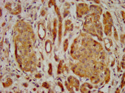 IHC image of CSB-PA722558LA01HU diluted at 1:400 and staining in paraffin-embedded human pancreatic cancer performed on a Leica BondTM system. After dewaxing and hydration, antigen retrieval was mediated by high pressure in a citrate buffer (pH 6....
