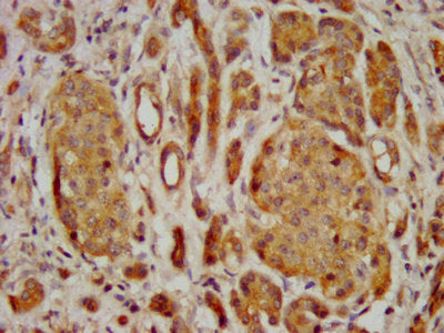 IHC image of CSB-PA722558LA01HU diluted at 1:400 and staining in paraffin-embedded human pancreatic cancer performed on a Leica BondTM system. After dewaxing and hydration, antigen retrieval was mediated by high pressure in a citrate buffer (pH 6....