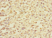 Immunohistochemistry of paraffin-embedded human melanoma using CSB-PA722563LA01HU at dilution of 1:100