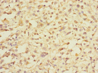 Immunohistochemistry of paraffin-embedded human melanoma using CSB-PA722563LA01HU at dilution of 1:100