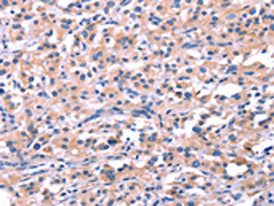 The image on the left is immunohistochemistry of paraffin-embedded Human thyroid cancer tissue using CSB-PA722618(FEM1B Antibody) at dilution 1/20, on the right is treated with synthetic peptide. (Original magnification: ×200)