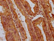 IHC image of CSB-PA722789LA01HU diluted at 1:400 and staining in paraffin-embedded human endometrial cancer performed on a Leica BondTM system. After dewaxing and hydration, antigen retrieval was mediated by high pressure in a citrate buffer (pH 6...