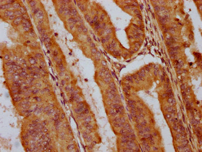 IHC image of CSB-PA722789LA01HU diluted at 1:400 and staining in paraffin-embedded human endometrial cancer performed on a Leica BondTM system. After dewaxing and hydration, antigen retrieval was mediated by high pressure in a citrate buffer (pH 6...