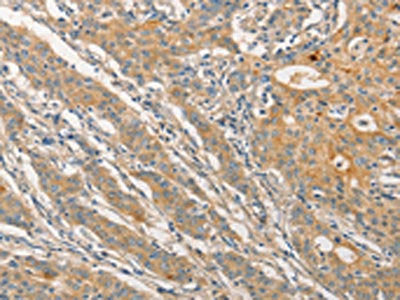 The image on the left is immunohistochemistry of paraffin-embedded Human gastic cancer tissue using CSB-PA724791(STAM Antibody) at dilution 1/40, on the right is treated with fusion protein. (Original magnification: ×200)