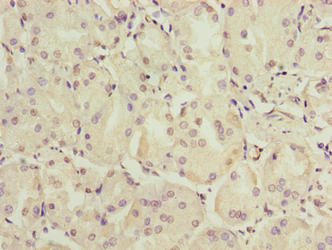 Immunohistochemistry of paraffin-embedded human gastric cancer using CSB-PA725558LA01HU at dilution of 1:100