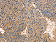 The image on the left is immunohistochemistry of paraffin-embedded Human liver cancer tissue using CSB-PA725644(GNB1 Antibody) at dilution 1/25, on the right is treated with fusion protein. (Original magnification: ×200)