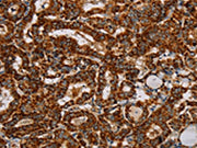 The image on the left is immunohistochemistry of paraffin-embedded Human thyroid cancer tissue using CSB-PA725678(NDUFS3 Antibody) at dilution 1/40, on the right is treated with fusion protein. (Original magnification: ×200)