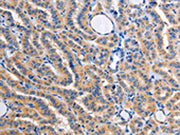 The image on the left is immunohistochemistry of paraffin-embedded Human thyroid cancer tissue using CSB-PA725690(ALG8 Antibody) at dilution 1/30, on the right is treated with fusion protein. (Original magnification: ×200)