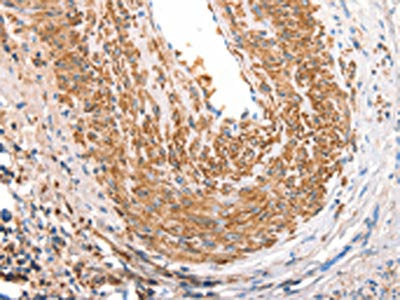 The image on the left is immunohistochemistry of paraffin-embedded Human cervical cancer tissue using CSB-PA725796(ART4 Antibody) at dilution 1/30, on the right is treated with synthetic peptide. (Original magnification: ×200)