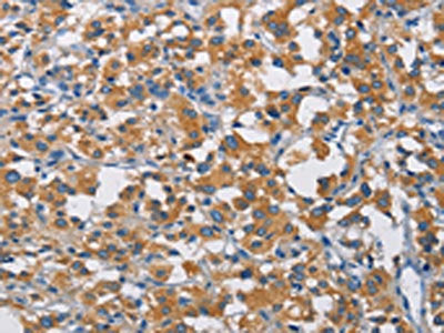 The image on the left is immunohistochemistry of paraffin-embedded Human thyroid cancer tissue using CSB-PA725805(CRTAM Antibody) at dilution 1/30, on the right is treated with fusion protein. (Original magnification: ×200)
