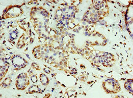 Immunohistochemistry of paraffin-embedded human breast cancer using CSB-PA726123ESR1HU at dilution of 1:100